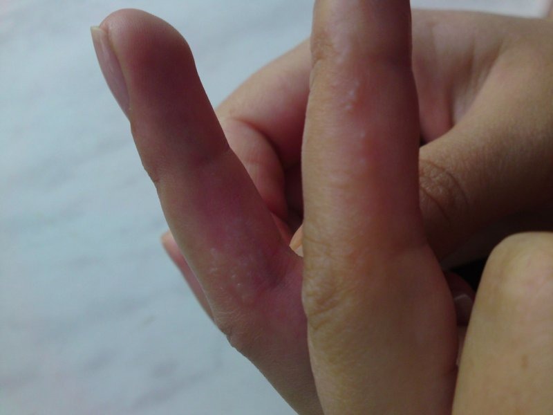 Тріщини на пальцях рук – причини проблеми